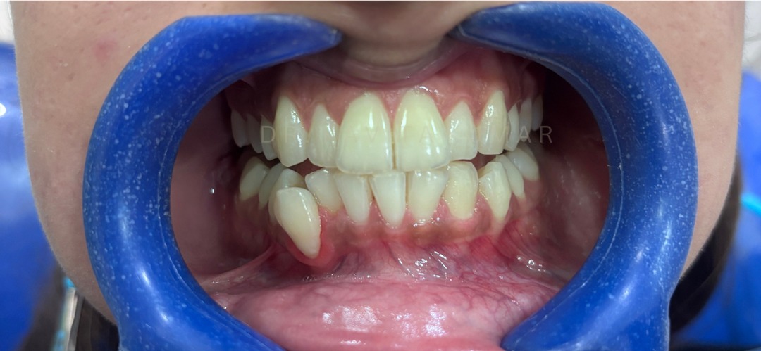 Before: Office Teeth Whitening