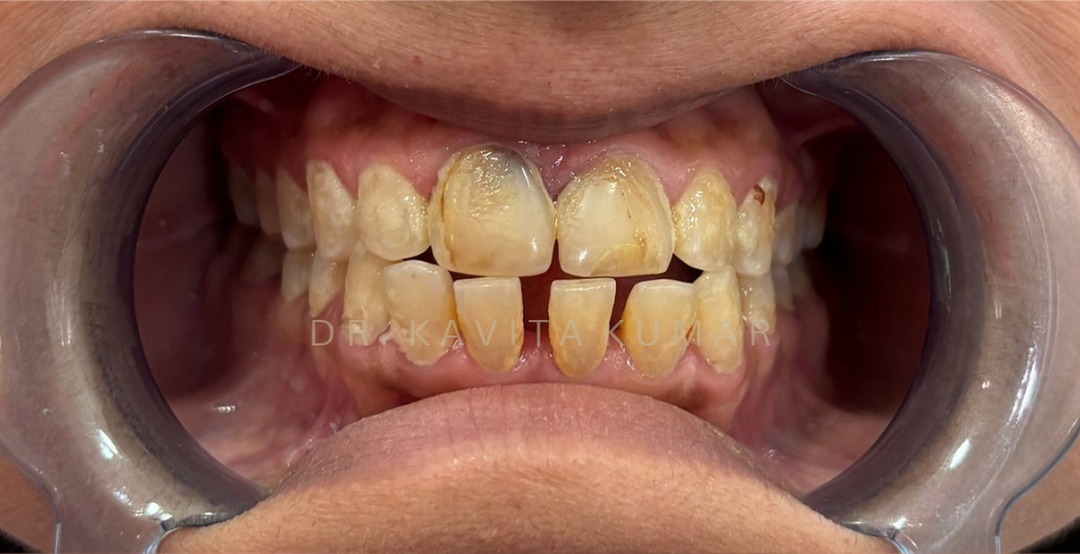 Before: Lower Anterior Veneers