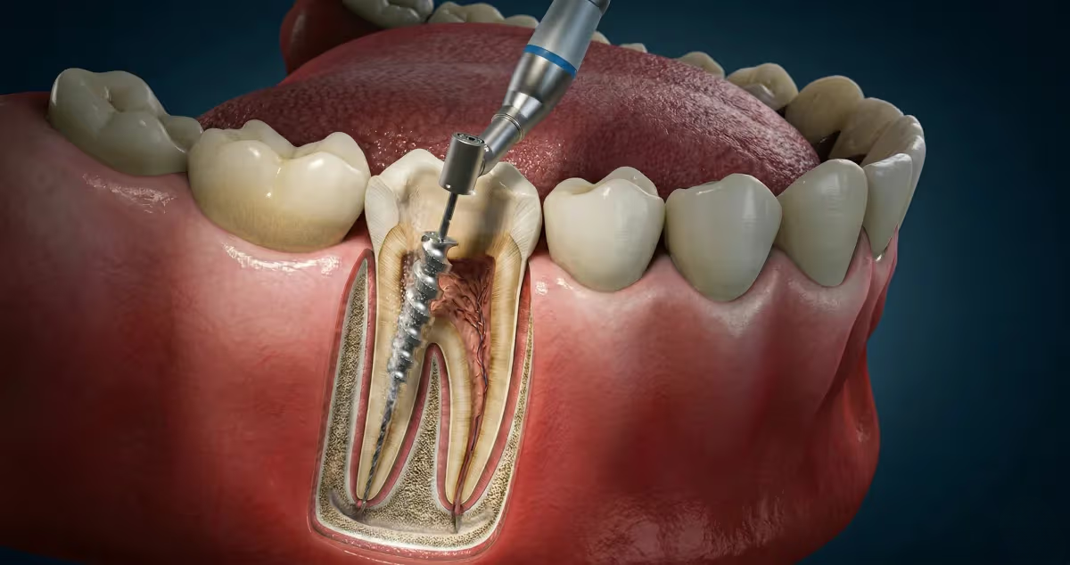 Root Canal Therapy treatment