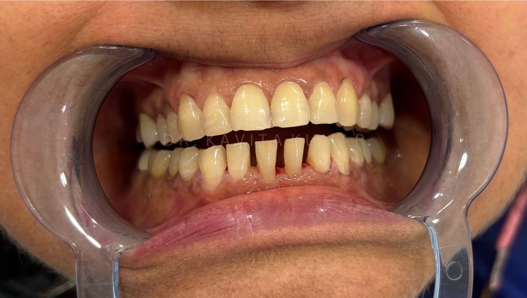 Before: Veneers
