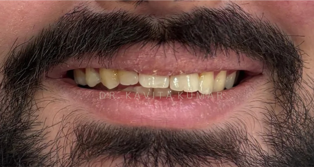 Before: Composite Bonding