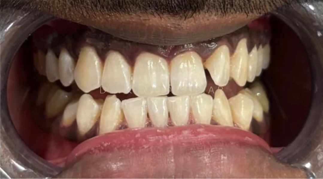 After: Zoom! Teeth Whitening