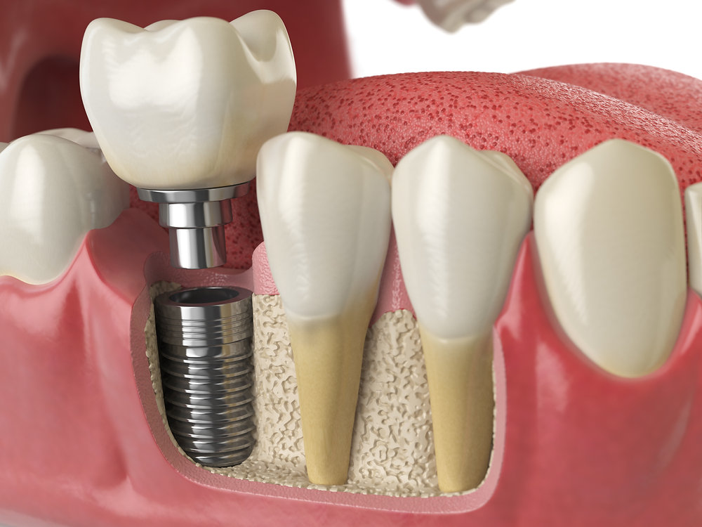 Two-Stage Implants