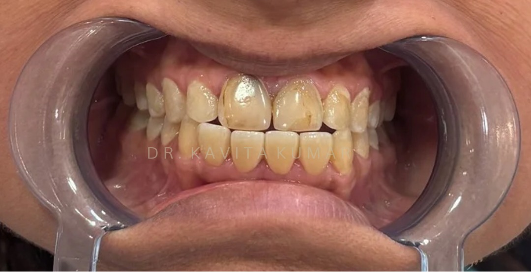 After: Lower Anterior Veneers