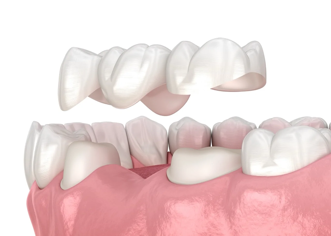 Zirconia Crowns & Veneers treatment
