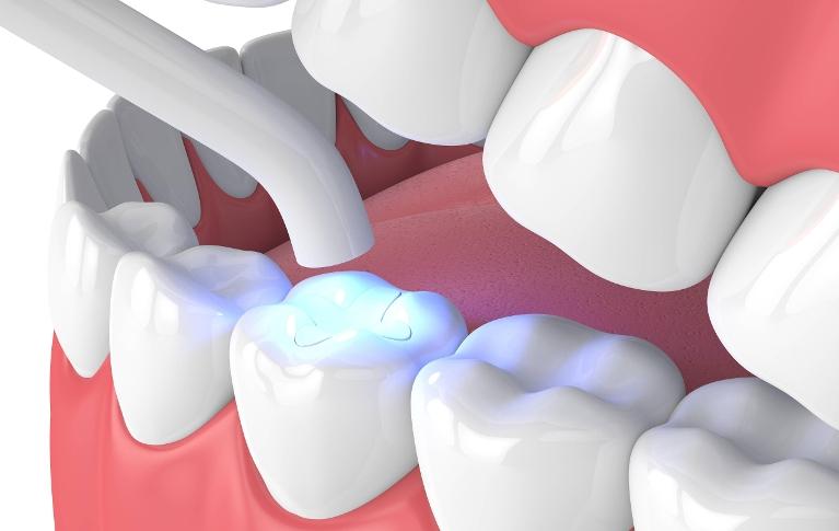 Tooth Colored Fillings — Cosmetic Dentistry