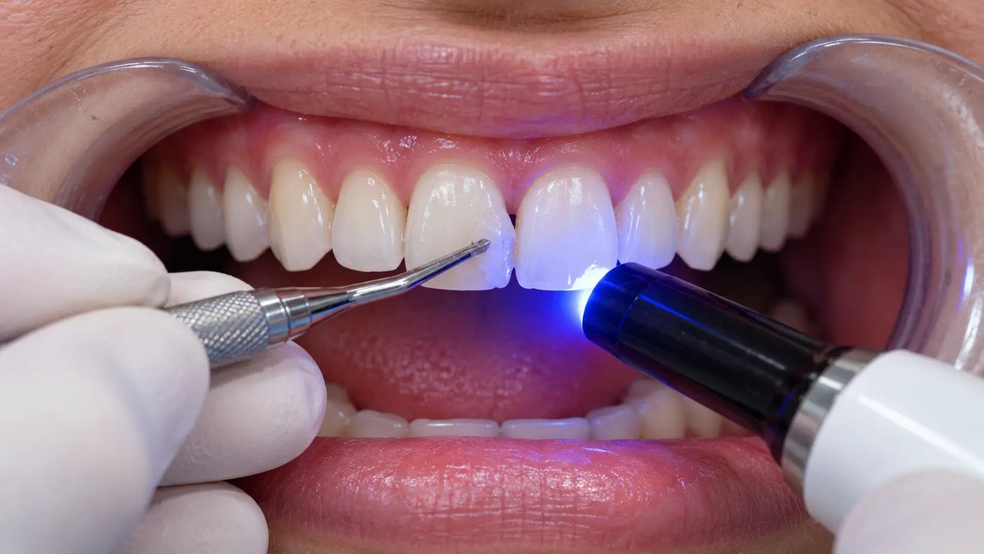 Composite bonding to close a gap between front teeth at Designer Smiles, Vile Parle East, Mumbai