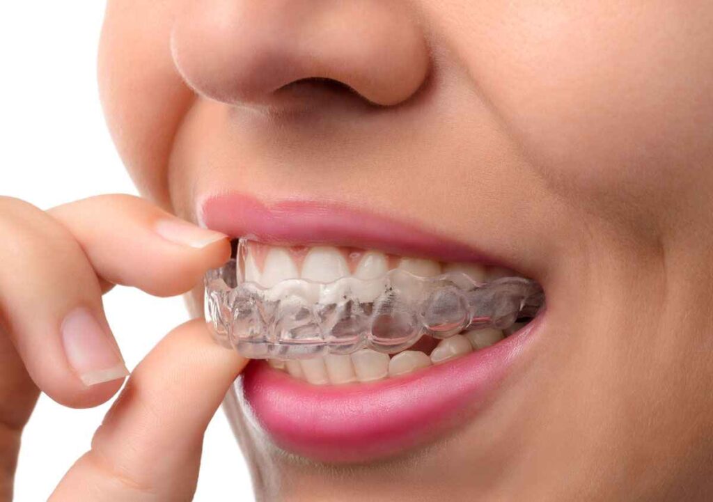 Custom dental night guard at Designer Smiles dental clinic in Vile Parle East, Mumbai
