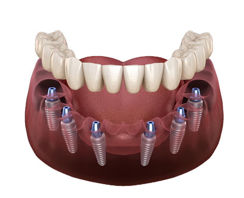All-on-6 dental implants at Designer Smiles dental clinic in Vile Parle East, Mumbai