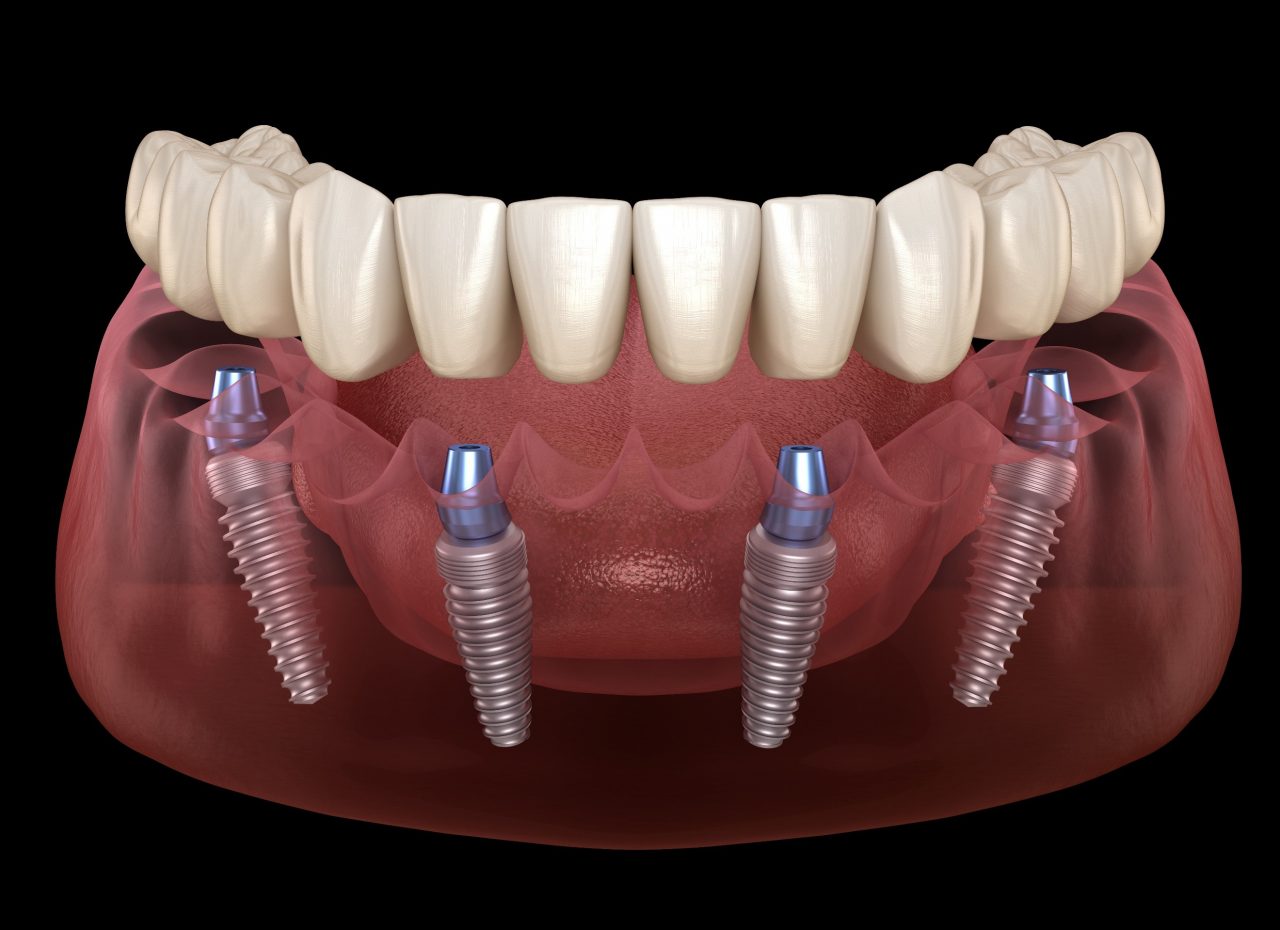 All-on-4 dental implants at Designer Smiles dental clinic in Vile Parle East, Mumbai
