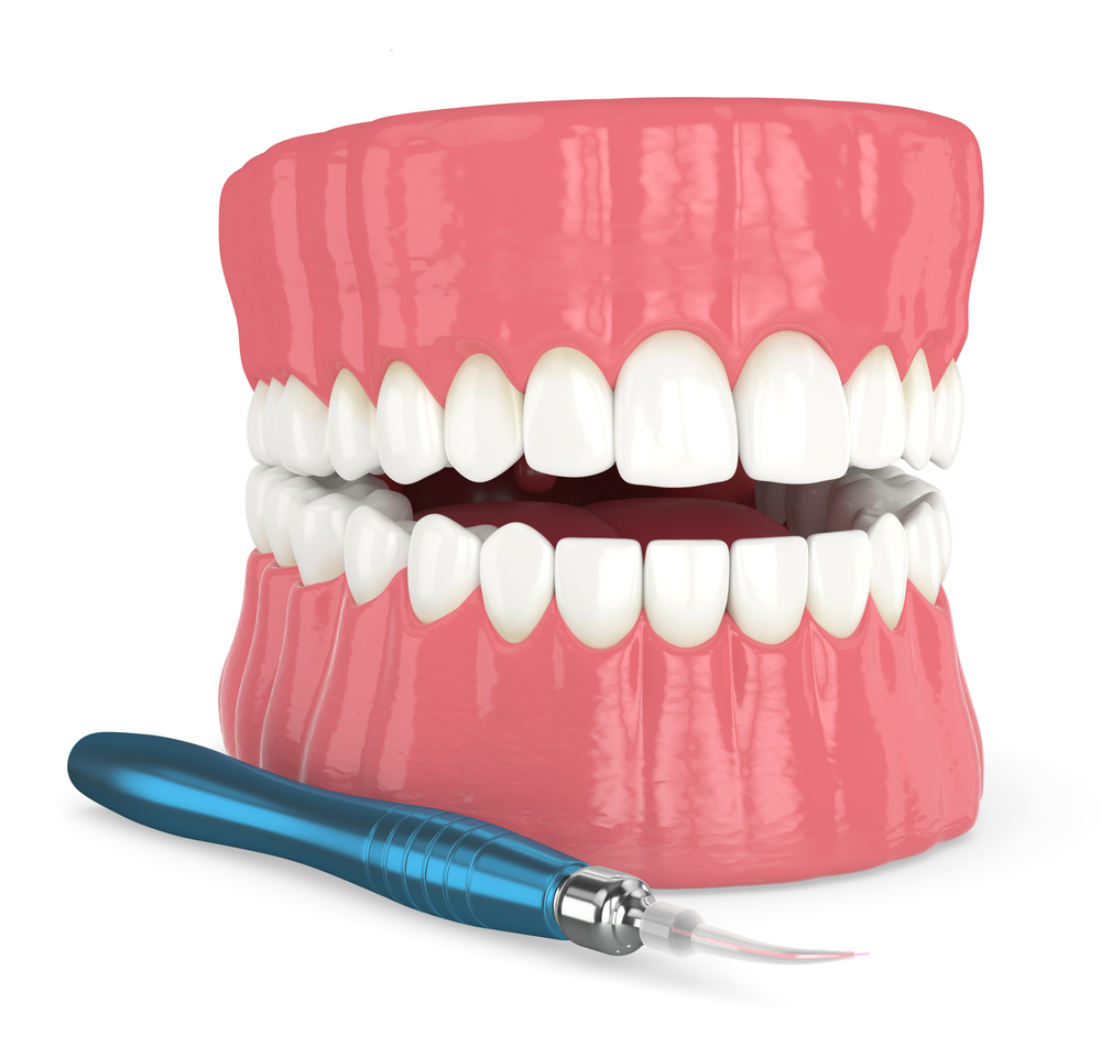 Laser frenectomy treatment at Designer Smiles dental clinic in Vile Parle East, Mumbai