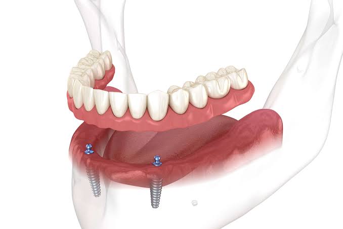 Implant-supported dentures at Designer Smiles dental clinic in Vile Parle East, Mumbai